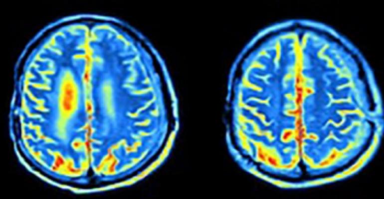 MRI of a brain