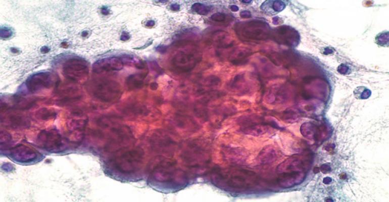 pleural effusion